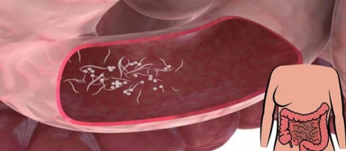 Qorxulu qurd xəstəliyi, Bağirsaq infeksiyalari, Bağırsaq infeksiyası nədir, Bağırsaq infeksiyalarının növləri