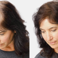 Saç transplantasiyası, Saç transplantasiyası qiyməti, saç əkdirəm, Saç transplantasiyası nələr daxildir, Saç əkimi növü Saç transplantasiyası, Saç transplantasiyası qiyməti, saç əkdirəm, Saç transplantasiyası nələr daxildir, Saç əkimi növü