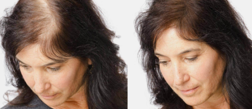 Saç transplantasiyası, Saç transplantasiyası qiyməti, saç əkdirəm, Saç transplantasiyası nələr daxildir, Saç əkimi növü