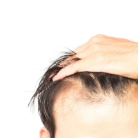 Saç transplantasiyası əməliyyatı, Saç transplantasiyası əməliyyatından əvvəl, Saç əkimi əməliyyatı Saç transplantasiyası əməliyyatı, Saç transplantasiyası əməliyyatından əvvəl, Saç əkimi əməliyyatı