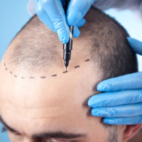 Saç transplantasiyası, Saç əkilməsi üsulları, Saç əkilməsi, Saç folikülü, Saç Nəqli, Saç Transplantında Qraftlar, Saç Nəqli Növləri Saç transplantasiyası, Saç əkilməsi üsulları, Saç əkilməsi, Saç folikülü, Saç Nəqli, Saç Transplantında Qraftlar, Saç Nəqli Növləri