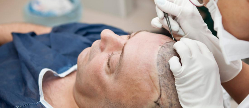 Saç əkimi Azərbaycan, Saç əkimi necə aparılır, Saç əkilməsi proseduru, Saç əkimindən əvvəl, Saç əkilməsi qiymətləri