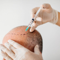 Saç əkimi Azərbaycan, Saç əkimi necə aparılır, Saç əkilməsi proseduru, Saç əkimindən əvvəl, Saç əkilməsi qiymətləri Saç əkimi Azərbaycan, Saç əkimi necə aparılır, Saç əkilməsi proseduru, Saç əkimindən əvvəl, Saç əkilməsi qiymətləri