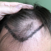 Saç tökülməsinə səbəbi, Saç transplantasiyası, FUE metod, Bakıda saç əkimi, Azərbaycanda saç əkilməsi proseduru Saç tökülməsinə səbəbi, Saç transplantasiyası, FUE metod, Bakıda saç əkimi, Azərbaycanda saç əkilməsi proseduru