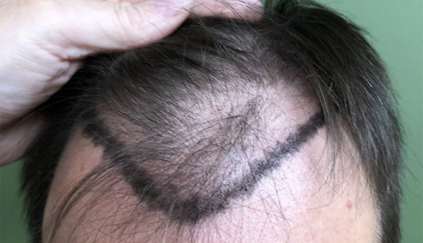 Saç tökülməsinə səbəbi, Saç transplantasiyası, FUE metod, Bakıda saç əkimi, Azərbaycanda saç əkilməsi proseduru