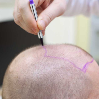 Saç tökülməsinə səbəbi, Saç transplantasiyası, FUE metod, Bakıda saç əkimi, Azərbaycanda saç əkilməsi proseduru Saç tökülməsinə səbəbi, Saç transplantasiyası, FUE metod, Bakıda saç əkimi, Azərbaycanda saç əkilməsi proseduru