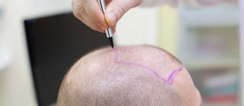 Saç tökülməsinə səbəbi, Saç transplantasiyası, FUE metod, Bakıda saç əkimi, Azərbaycanda saç əkilməsi proseduru