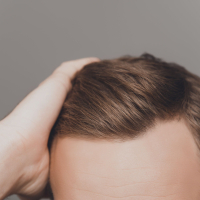 Saç transplantasiyası, Saç transplantasiyası qiyməti, saç əkdirəm, Saç transplantasiyası nələr daxildir, Saç əkimi növü Saç transplantasiyası, Saç transplantasiyası qiyməti, saç əkdirəm, Saç transplantasiyası nələr daxildir, Saç əkimi növü