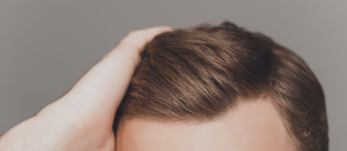 Saç transplantasiyası, Saç transplantasiyası qiyməti, saç əkdirəm, Saç transplantasiyası nələr daxildir, Saç əkimi növü