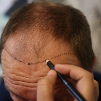 Fue Saç Nəqli, Follikulyar vahid ekstraksiya FUE, Fue Saç əkilməsi Nəticələri, Saç transplantasiyası Fue Saç Nəqli, Follikulyar vahid ekstraksiya FUE, Fue Saç əkilməsi Nəticələri, Saç transplantasiyası