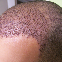 Saç əkimi əməliyyatı nədir, Saç transplantasiyası, Kişi tipi saç tökülməsi, Saç əkilməsi texnikaları, Saç follikulları Saç əkimi əməliyyatı nədir, Saç transplantasiyası, Kişi tipi saç tökülməsi, Saç əkilməsi texnikaları, Saç follikulları