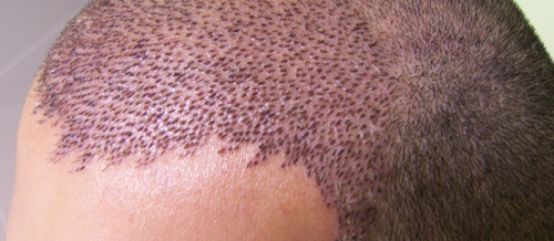 Saç əkimi əməliyyatı nədir, Saç transplantasiyası, Kişi tipi saç tökülməsi, Saç əkilməsi texnikaları, Saç follikulları