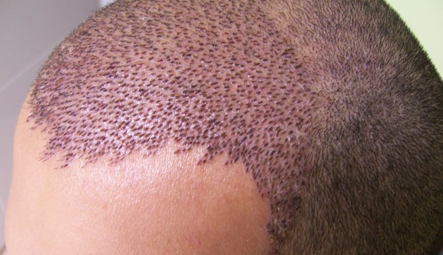 Saç əkimi əməliyyatı nədir, Saç transplantasiyası, Kişi tipi saç tökülməsi, Saç əkilməsi texnikaları, Saç follikulları