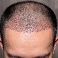 Saç əkimi əməliyyatı nədir, Saç transplantasiyası, Kişi tipi saç tökülməsi, Saç əkilməsi texnikaları, Saç follikulları Saç əkimi əməliyyatı nədir, Saç transplantasiyası, Kişi tipi saç tökülməsi, Saç əkilməsi texnikaları, Saç follikulları