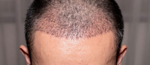 Saç əkimi əməliyyatı nədir, Saç transplantasiyası, Kişi tipi saç tökülməsi, Saç əkilməsi texnikaları, Saç follikulları