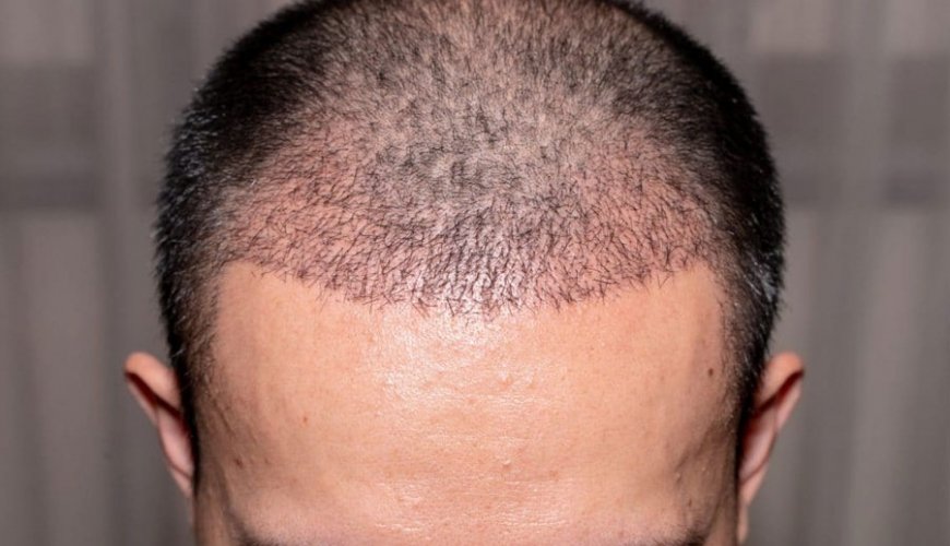 Saç əkimi əməliyyatı nədir, Saç transplantasiyası, Kişi tipi saç tökülməsi, Saç əkilməsi texnikaları, Saç follikulları