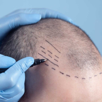 Saç transplantasiyası, Saç transplantasiyası qiyməti, saç əkdirəm, Saç transplantasiyası nələr daxildir, Saç əkimi növü Saç transplantasiyası, Saç transplantasiyası qiyməti, saç əkdirəm, Saç transplantasiyası nələr daxildir, Saç əkimi növü