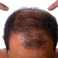 Saç əkilməsi, FUE üsulu, saç tökülməsi, androgenetik alopesi, saç əkim proseduru, Greft Saç əkilməsi, FUE üsulu, saç tökülməsi, androgenetik alopesi, saç əkim proseduru, Greft