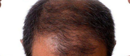 Saç əkilməsi, FUE üsulu, saç tökülməsi, androgenetik alopesi, saç əkim proseduru, Greft