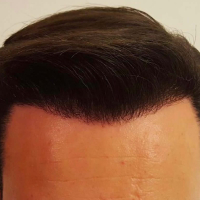 Saç Transplantasiya Mərkəzi, Saç Transplantasiyası nədir, Azərbaycanda saç əkimi, Saç transplantasiyası üsulları Saç Transplantasiya Mərkəzi, Saç Transplantasiyası nədir, Azərbaycanda saç əkimi, Saç transplantasiyası üsulları