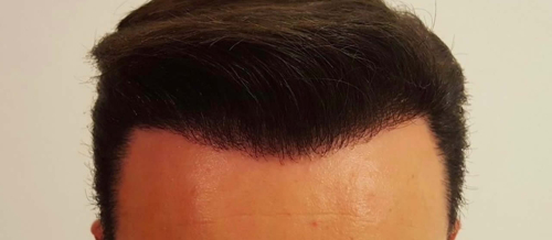 Saç Transplantasiya Mərkəzi, Saç Transplantasiyası nədir, Azərbaycanda saç əkimi, Saç transplantasiyası üsulları