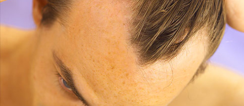 Saç əkimi, Bakıda saç əkimi, Saç əkimi Metodu, Azərbaycanda saç əkimi proseduru, Saç əkimi qiymətləri