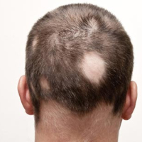 Sac əkilməsi, Saç tökülmesi və Müalicəsi, Kişilərdə Saçların tökülmesi, Qaş əkilməsi Sac əkilməsi, Saç tökülmesi və Müalicəsi, Kişilərdə Saçların tökülmesi, Qaş əkilməsi