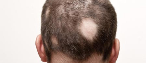 Sac əkilməsi, Saç tökülmesi və Müalicəsi, Kişilərdə Saçların tökülmesi, Qaş əkilməsi