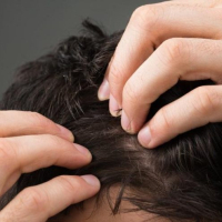 Ən effektiv saç əkimi metodları, saç əkimi üsulları, Sapphire saç transplantasiyası, DHI Birbaşa Saç İmplantı Ən effektiv saç əkimi metodları, saç əkimi üsulları, Sapphire saç transplantasiyası, DHI Birbaşa Saç İmplantı