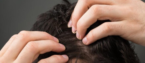 Ən effektiv saç əkimi metodları, saç əkimi üsulları, Sapphire saç transplantasiyası, DHI Birbaşa Saç İmplantı