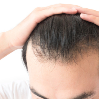 Saç əkimi cərrahı, Saç əkilməsi üçün donor tüklər, Saç əkimi prosesi, Bakıda saç əkimi Saç əkimi cərrahı, Saç əkilməsi üçün donor tüklər, Saç əkimi prosesi, Bakıda saç əkimi