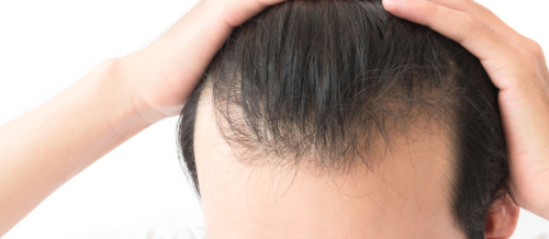 Saç əkimi cərrahı, Saç əkilməsi üçün donor tüklər, Saç əkimi prosesi, Bakıda saç əkimi