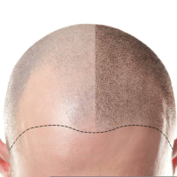 Saç əkilməsi, FUE üsulu, saç tökülməsi, androgenetik alopesi, saç əkim proseduru, Greft Saç əkilməsi, FUE üsulu, saç tökülməsi, androgenetik alopesi, saç əkim proseduru, Greft