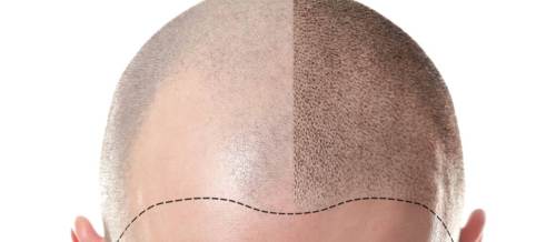 Saç əkilməsi, FUE üsulu, saç tökülməsi, androgenetik alopesi, saç əkim proseduru, Greft