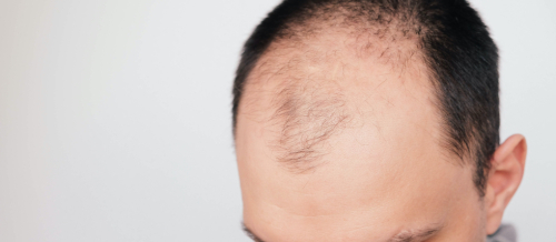 Saç əkimi cərrahı, Saç əkilməsi üçün donor tüklər, Saç əkimi prosesi, Bakıda saç əkimi