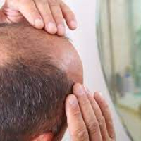 Saç əkimi necə aparılır, Saç əkimi nədir, Saç əkmə üsulları hansılardır, Saç əkimi necə tətbiq olunur Saç əkimi necə aparılır, Saç əkimi nədir, Saç əkmə üsulları hansılardır, Saç əkimi necə tətbiq olunur