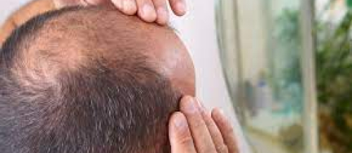 Saç əkimi necə aparılır, Saç əkimi nədir, Saç əkmə üsulları hansılardır, Saç əkimi necə tətbiq olunur