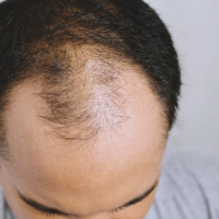 Saç əkimi necə aparılır, Saç əkimi nədir, Saç əkmə üsulları hansılardır, Saç əkimi necə tətbiq olunur Saç əkimi necə aparılır, Saç əkimi nədir, Saç əkmə üsulları hansılardır, Saç əkimi necə tətbiq olunur