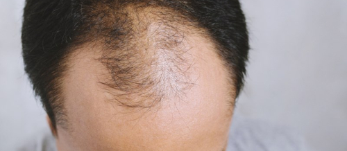 Saç əkimi necə aparılır, Saç əkimi nədir, Saç əkmə üsulları hansılardır, Saç əkimi necə tətbiq olunur