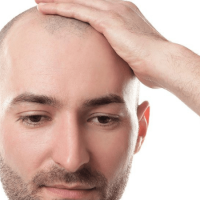 Saç əkilməsi, FUE üsulu, saç tökülməsi, androgenetik alopesi, saç əkim proseduru, Greft Saç əkilməsi, FUE üsulu, saç tökülməsi, androgenetik alopesi, saç əkim proseduru, Greft