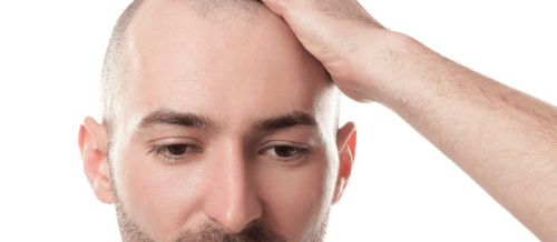 Saç əkilməsi, FUE üsulu, saç tökülməsi, androgenetik alopesi, saç əkim proseduru, Greft