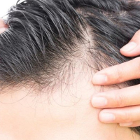 Saç Əkimi, saç əkimi mütəxəssisi, saç əkmə üsulları, Tikişsiz üsul FUE, Saç transplantasiyası Saç Əkimi, saç əkimi mütəxəssisi, saç əkmə üsulları, Tikişsiz üsul FUE, Saç transplantasiyası