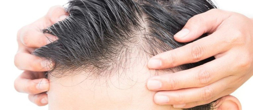 Saç Əkimi, saç əkimi mütəxəssisi, saç əkmə üsulları, Tikişsiz üsul FUE, Saç transplantasiyası