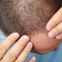 Saç Əkimi, saç əkimi mütəxəssisi, saç əkmə üsulları, Tikişsiz üsul FUE, Saç transplantasiyası Saç Əkimi, saç əkimi mütəxəssisi, saç əkmə üsulları, Tikişsiz üsul FUE, Saç transplantasiyası