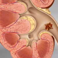 Sidik daşı xəstəliyi, Sidik daşı növləri, Sidik daşı xəstəliyi müalicəsi, Uroloq androloq
