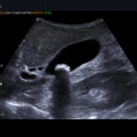 Ultrasəs müayinəsi, USM VƏ DOPLEROQRAFİYA, USM-diaqnostika nədir, Süd vəzilərinin USM-i