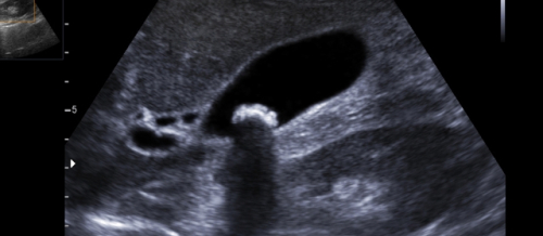 Ultrasəs müayinəsi, USM VƏ DOPLEROQRAFİYA, USM-diaqnostika nədir, Süd vəzilərinin USM-i